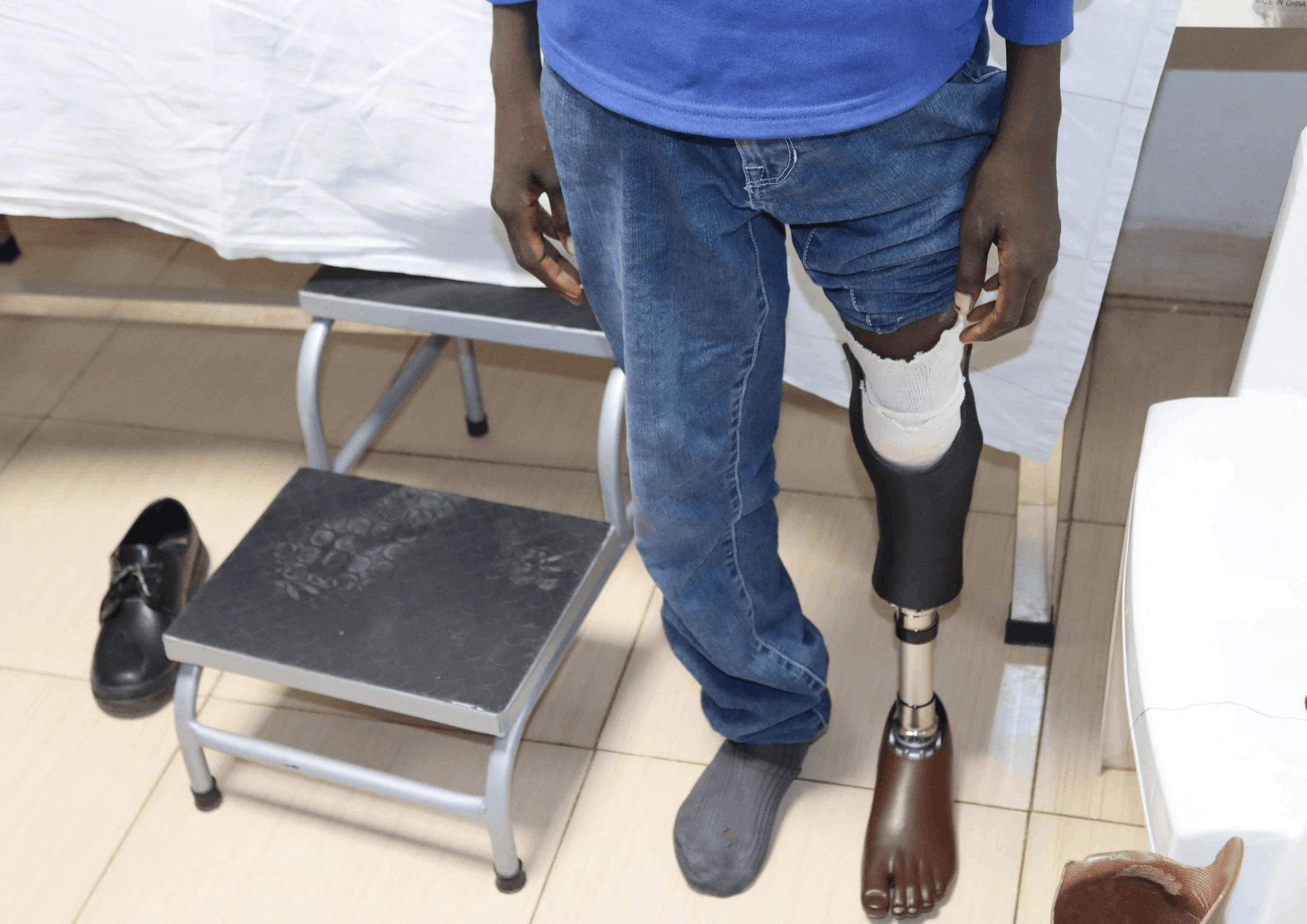 Prosthetics Fabrication and Fitting at HMRC Nigeria